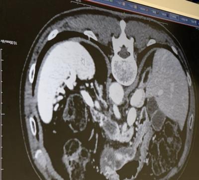 見つかっちゃった!ガン細胞、オペ入院!