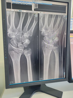 骨を折りに行った屋久島：1日目　転んで右手を骨折