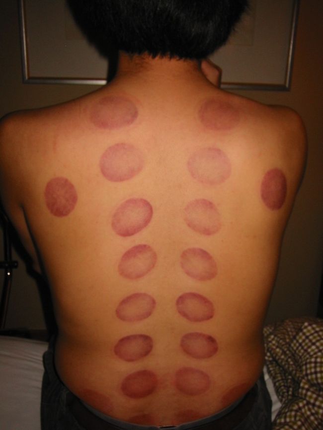 で、ホテルを出て明洞を散歩。<br />明洞汗蒸幕へ。アカスリとカッピング（４９０００㌆）。<br />アカスリは、いろいろあって恥ずかしかった・・・・。<br />カッピングは、大きな洗濯ばさみで背中をつねられているみたいで痛い。でも、気持ちよかった。<br />（背中の跡は1週間ほどとれなかった）。<br />明らかに体が軽くなる。