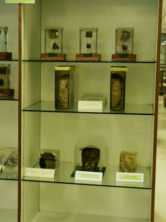 法医学（シーウィー）博物館のホルマリン漬けの人体標本。