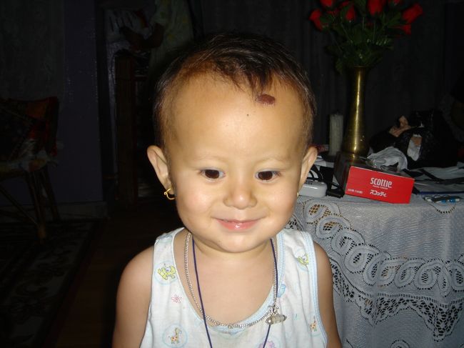 Ｒの子供<br />転んで、おでこに傷