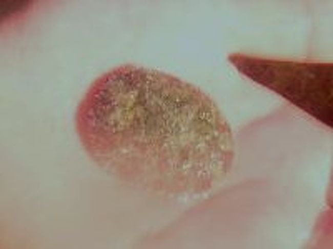 タコノマクラ。<br />磯遊びをするときは襟足、シュノーケリングをするときは脹脛の日焼けに気をつけましょう。