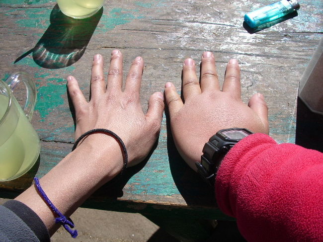 *番外編*その1。<br />人によってこんなにむくむのです。<br />不思議。