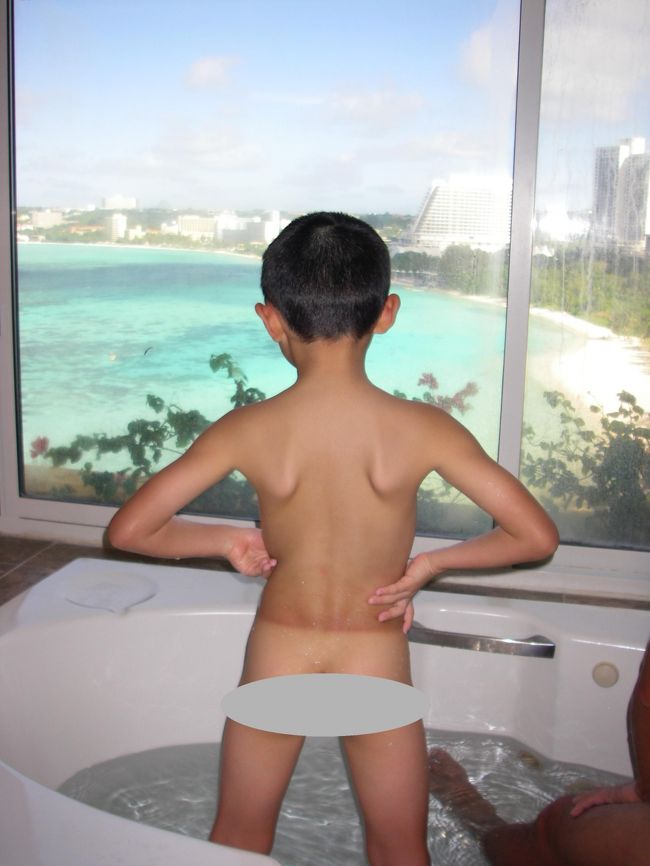 海にいる時間が長〜い我が家<br /><br />息子には基本ラッシュガード着せてるんですが<br />ウォータースライダーは裸のほうがスピード出るとかで<br />時々脱いでたらしく‥この日焼けです<br /><br />失礼しました（−＿−）<br /><br />