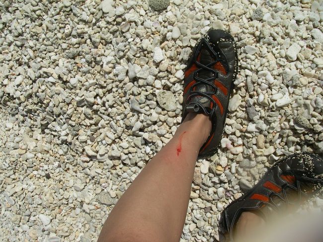 サンゴでぶつけて流血騒ぎ<br /><br />弁慶だったので、異常に痛かった！！<br /><br />で、帰国しても全然良くならず、未だに痕が濃く残ってしまった。<br />ちなみに1ヶ月してもふさがらなかったので、サンゴの菌が入っちゃったんじゃないかと思った。そのうちサンゴが生えてくるのを待っていたが、ふさがった。<br /><br />今思えば、皮膚科に行くべきだった。