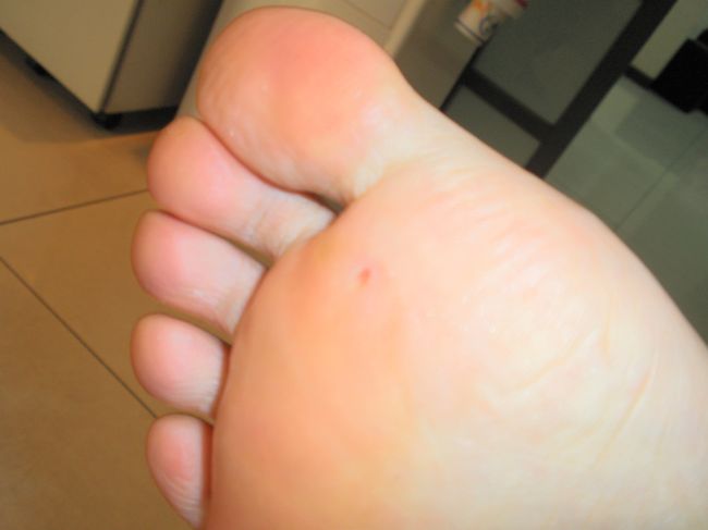 皮膚のかたくなっているところを削ってもらって、きれいになりました。こちらの人はしょちゅう削っているらしい。