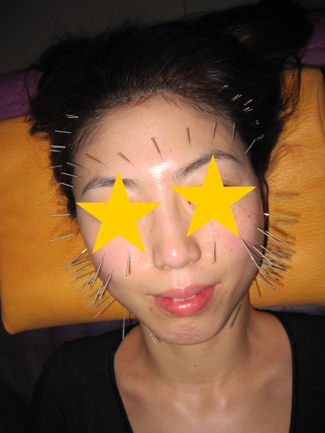 お見苦しい写真ですが……！！！<br /><br />ぽっぺた付近は、ピストルのようなもので、鍼を打っている様子でした。<br />音が怖いっっ（＠o＠；）<br /><br />私は、額が一番痛かったのですが、<br />同行のお先輩二人は、耳の付け根（リンパ腺にそったとこ）が痛かったそうです。<br />個人差があるようですね。<br /><br />一人は、施術後すぐに、「顔が上がった！！」と感激★☆★<br />私と、もう一人は、施術後１日は、だいぶ痛みが残りました。<br /><br />でもでも、２，３日後には、痛みがひき、な・ん・と！<br />おでこの皺がすっきりなくなりました♪♪♪<br /><br />３人同時だった為、時間の都合で、私一人、マッサージより先に美顔鍼と、<br />順番が逆転してとっても怖かったのですが、行って良かった（＾o＾)/<br />