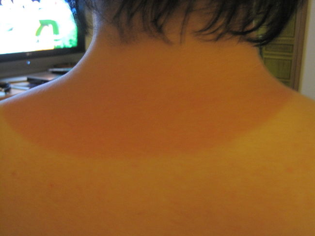 そして王子の日焼け（笑）