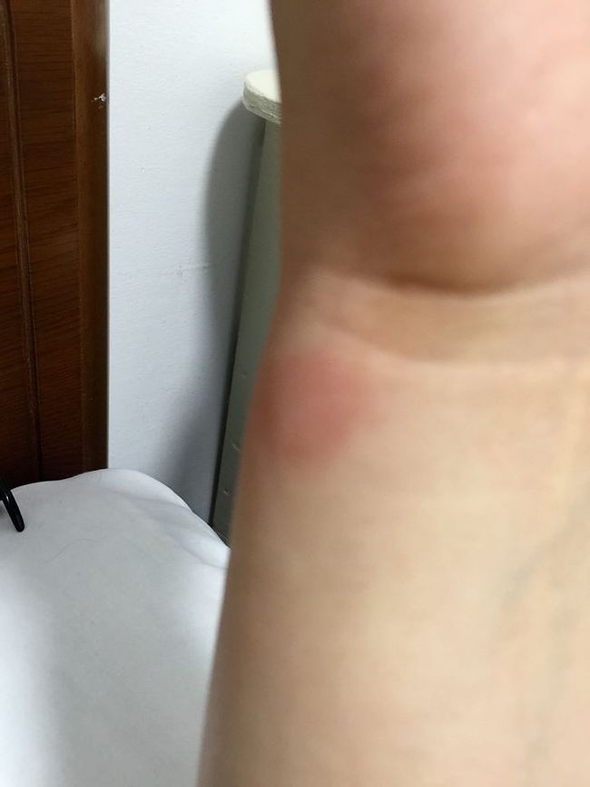 そういえばサンゴに刺された跡が痛む。<br />グローブとウェットのわずかな隙間にサンゴが触れたらしく<br />バチ！っと痛みが。サンゴに毒があるなんて思わなんだ。<br />ひどいとサンゴ皮膚炎って言って、数ヶ月治らないみたいだけど<br />ひどくなりませんよーに。<br />