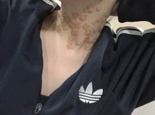 首に出来た小さいイボをレーザーで取りました<br /><br />あっても10個くらいかな？と思ってたら想像以上に多くてこんな姿に…笑<br /><br />でも首元が綺麗になったから大満足です！<br /><br />日焼けＮＧなのでシールを貼って過ごしました(＞人＜;)<br /><br />写真はポーズをとっているわけではなく、髪を上にあげてるだけです