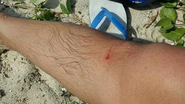 擦り傷になってました。<br />ラッシュガード着ていた方が無難です。