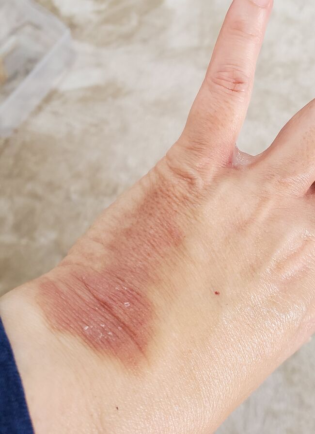 ギャー　手を振りましたが落ちないので　右手で払い　落ちたであろう地面を踏みつけていました(巣があったら大変でしたね)<br />その時は痛くも痒くもないのでそのままにしていました<br />腫れに気がついたのはホテルについてからです　赤く腫れ　痛痒い　手を洗い　ウナクールを塗っておいたが　ずっと炎症おさまらず　帰国後皮膚科で抗生物質と痒み止めクリームを貰った<br />写真は２週間後の状況です<br />昨日から一部皮膚が白く剥がれてきています<br />皮膚が剥がれてもとに戻るのかしら？<br />